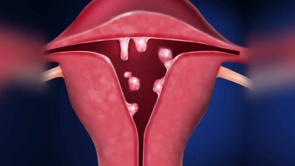 Polip endometrijuma – histeroskopija ili eksplorativna kiretaža ?